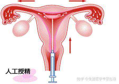 香港验血样本能保存几天,人工受精双胞胎一次多少钱？人工授精备孕须知!