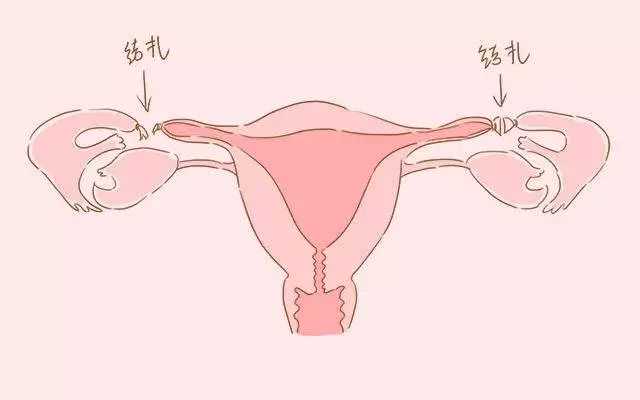 成都香港验血查性别,输卵管结扎以后可以复通也可以做试管婴儿#清风计划#