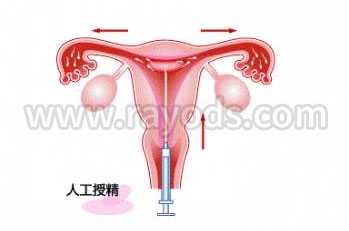 香港验血男女 下午出结果 紧张,工授精技术（IUI）能圆不孕不育男女生育的梦适
